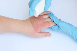 Common Misconceptions About Burn Injuries in Georgia
