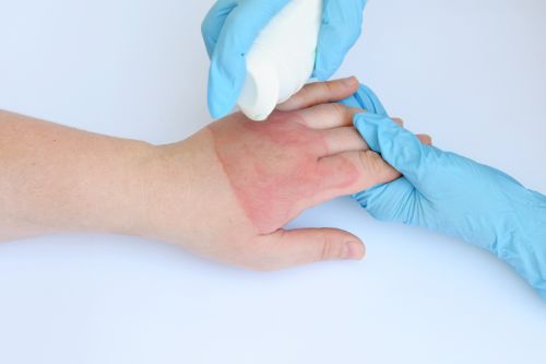 Can I file a burn injury lawsuit if the accident happened at my workplace